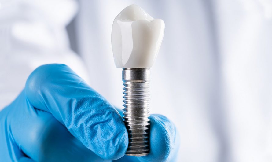 Одномоментная имплантация зубов: новейшая технология в стоматологии